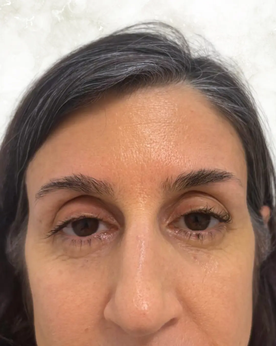 botox after-1