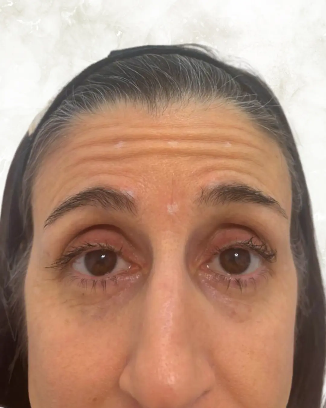 botox before-1