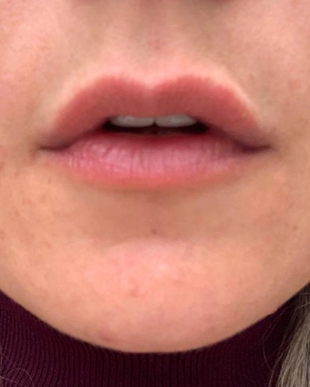 labios after-1 labios after-1